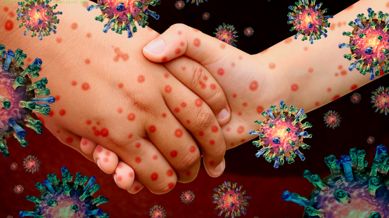 Корь. Меры профилактики.