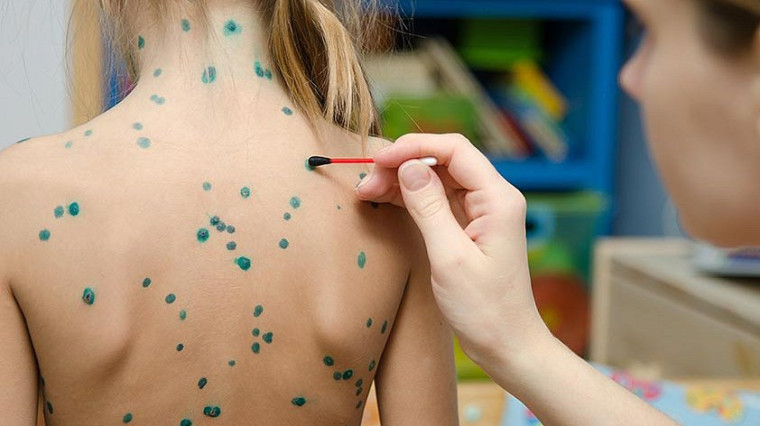 Профилактика ветряной оспы