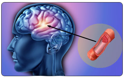 Причины и профилактика инсульта